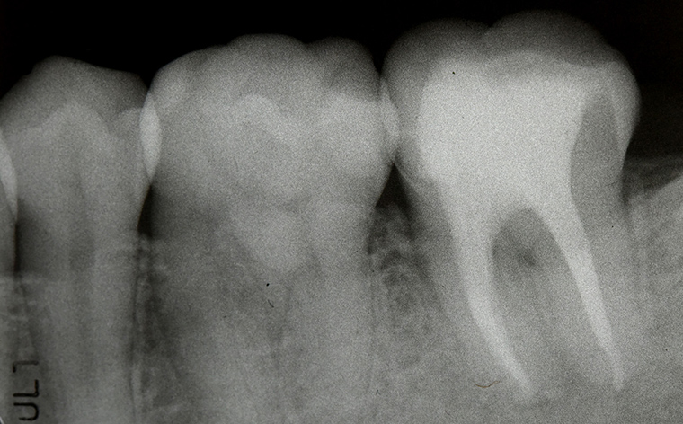 神経を取った歯は、処置内容をレントゲン確認