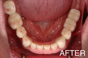 【インプラント症例１６】歯の欠損放置により、噛み合わせがおかしくなった患者さま