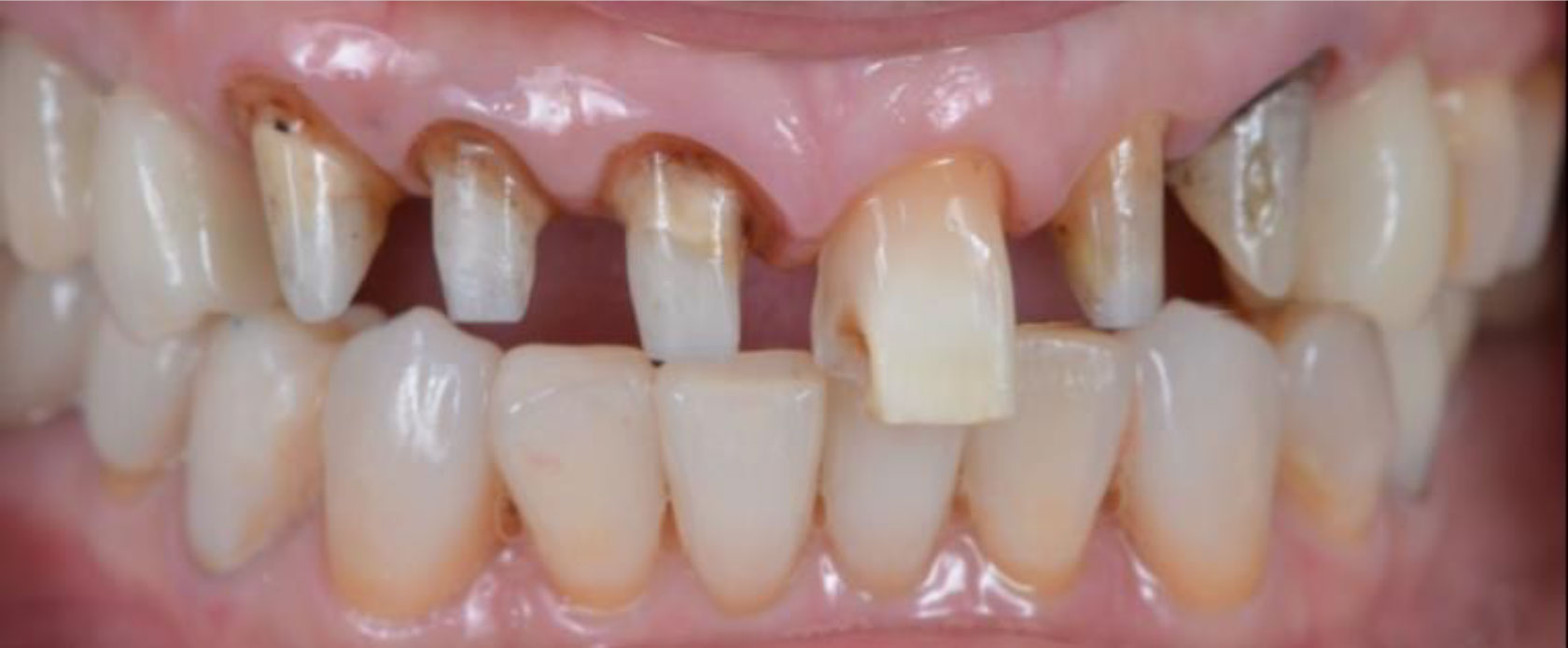 前歯の根本が黒くなり、審美性にこだわる治診療をご希望された患者さま