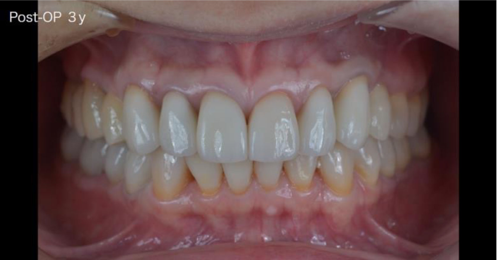 前歯の根本が黒くなり、審美性にこだわる治診療をご希望された患者さま