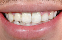 【インプラント症例２】折れた歯のインプラント治療