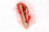 【インプラント症例２】折れた歯のインプラント治療