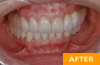 【インプラント症例６】多数歯欠損インプラント (インプラント総合的治療)