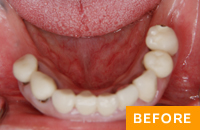 【インプラント症例６】多数歯欠損インプラント (インプラント総合的治療)