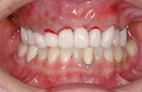 【インプラント症例３】インプラントによる上の歯の再建