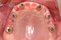 【インプラント症例３】インプラントによる上の歯の再建