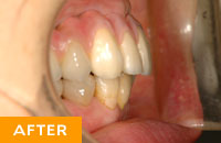 【インプラント症例１】入れ歯からインプラントへ
