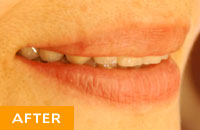 【インプラント症例１】入れ歯からインプラントへ