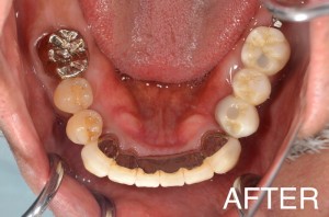 【インプラント症例１０】重度歯周病で歯がぐらつき、食事もできなかった患者さま