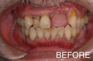 【インプラント症例１０】重度歯周病で歯がぐらつき、食事もできなかった患者さま