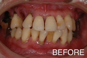 【インプラント症例１１】重度歯周病で歯がぐらつき、食事もできなかった患者さま
