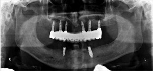 【インプラント症例１１】重度歯周病で歯がぐらつき、食事もできなかった患者さま