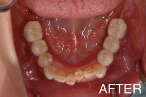 【インプラント症例１２】歯を失い、長期放置していた患者さま