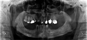 【インプラント症例１２】歯を失い、長期放置していた患者さま