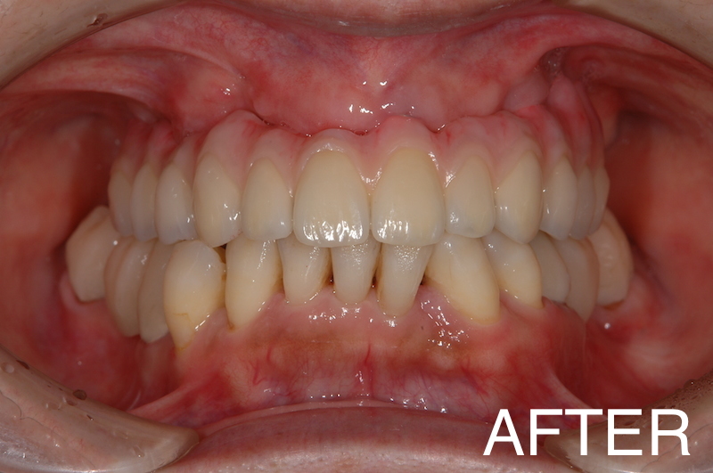 【インプラント症例１３】重度歯周病で歯がぐらつき、食事もできなかった患者さま