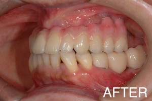 【インプラント症例１３】重度歯周病で歯がぐらつき、食事もできなかった患者さま