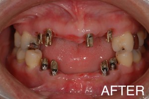 【インプラント症例１４】若くして、重度歯周病で歯が激しく動揺した患者さま