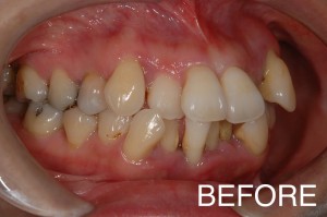 【インプラント症例１４】若くして、重度歯周病で歯が激しく動揺した患者さま