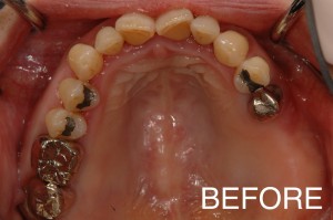【インプラント症例１５】昔入れたブリッジが壊れ、歯根も駄目になってしまった患者さま