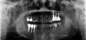 【インプラント症例１５】昔入れたブリッジが壊れ、歯根も駄目になってしまった患者さま