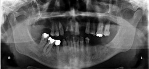 【インプラント症例１６】歯の欠損放置により、噛み合わせがおかしくなった患者さま