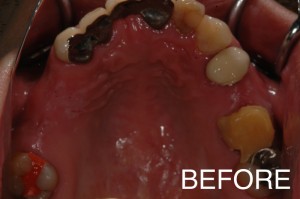 【インプラント症例１７】歯医者がコワくて歯をどんどん失ってしまった患者さま