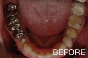 【インプラント症例１７】歯医者がコワくて歯をどんどん失ってしまった患者さま