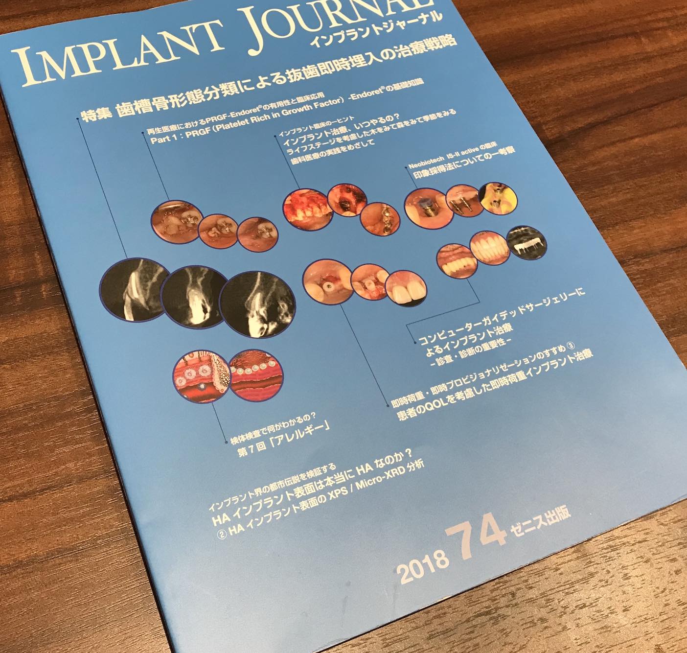 【歯科医師向け情報】【症例掲載】インプラントジャーナル 2018年74号にて症例を紹介しています