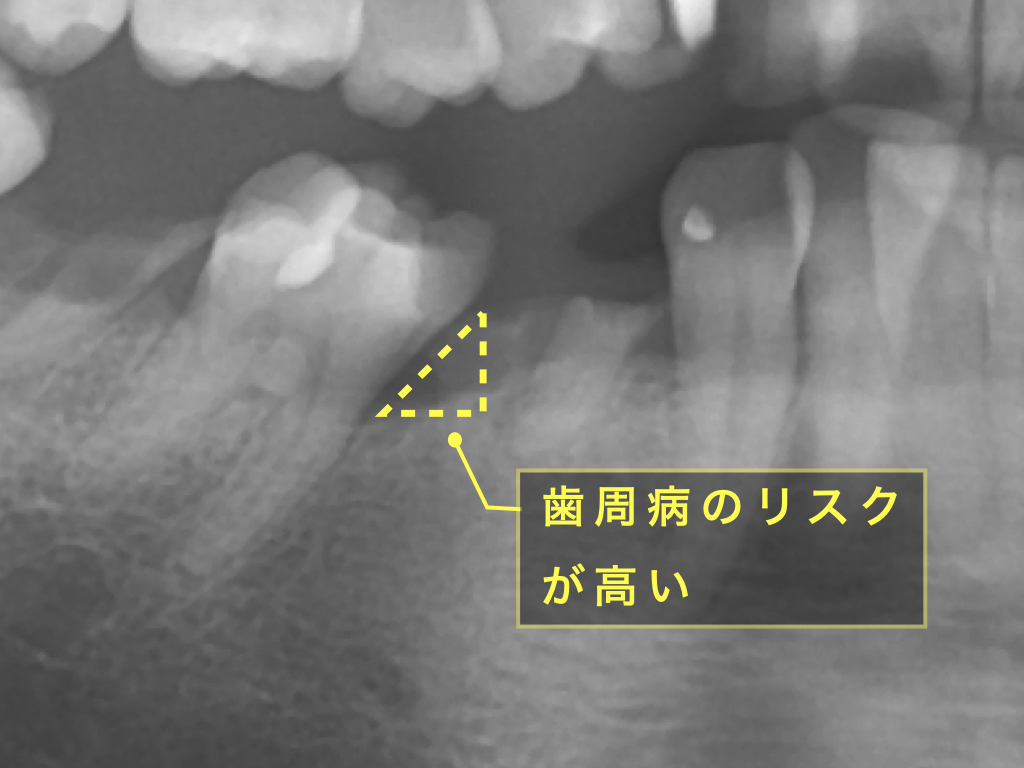 部分矯正①　〜隣の歯がなくなって歯が倒れてきた場合〜