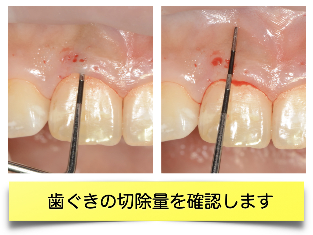 【ガミースマイル治療①】歯が生えきってない場合