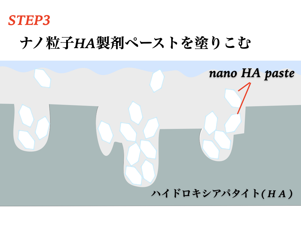 むし歯を削らずに治す方法を解説（歯科衛生士）