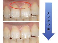 【初期むし歯を削らずに治す方法】〜衛生士によるナノケア〜