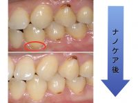 【初期むし歯を削らずに治す方法】〜衛生士によるナノケア〜