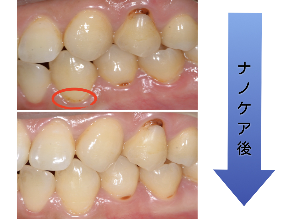 初期むし歯を削らずに治す方法】〜衛生士によるナノケア〜｜大阪の