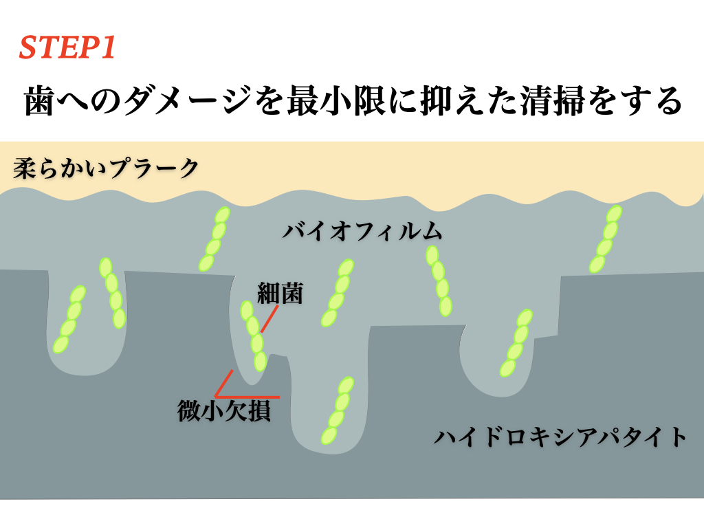 むし歯を削らずに治す方法を解説（歯科衛生士）