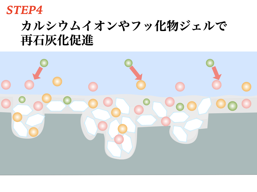 むし歯を削らずに治す方法を解説（歯科衛生士）