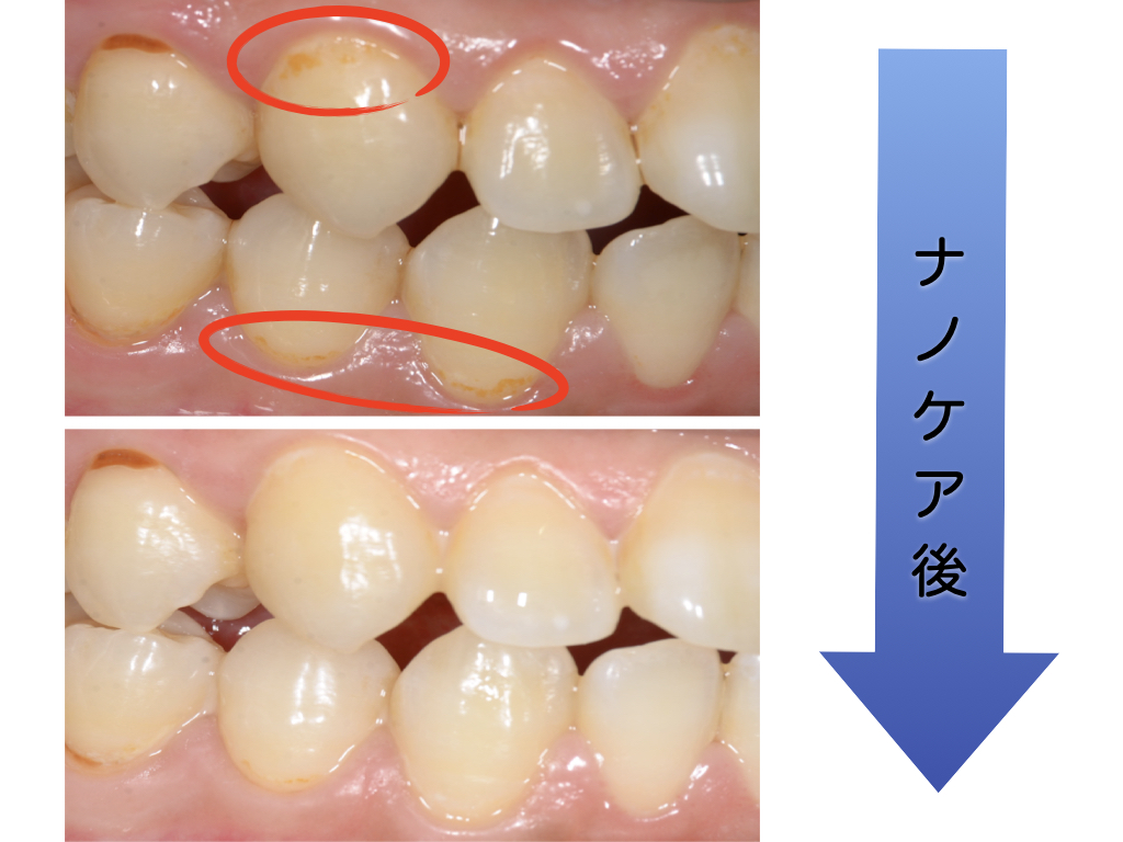 初期むし歯を削らずに治す方法 衛生士によるナノケア