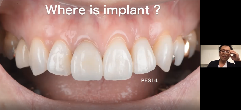 歯科医師の先生も迷った！？天然歯との見分けが難しい当院のインプラント治療