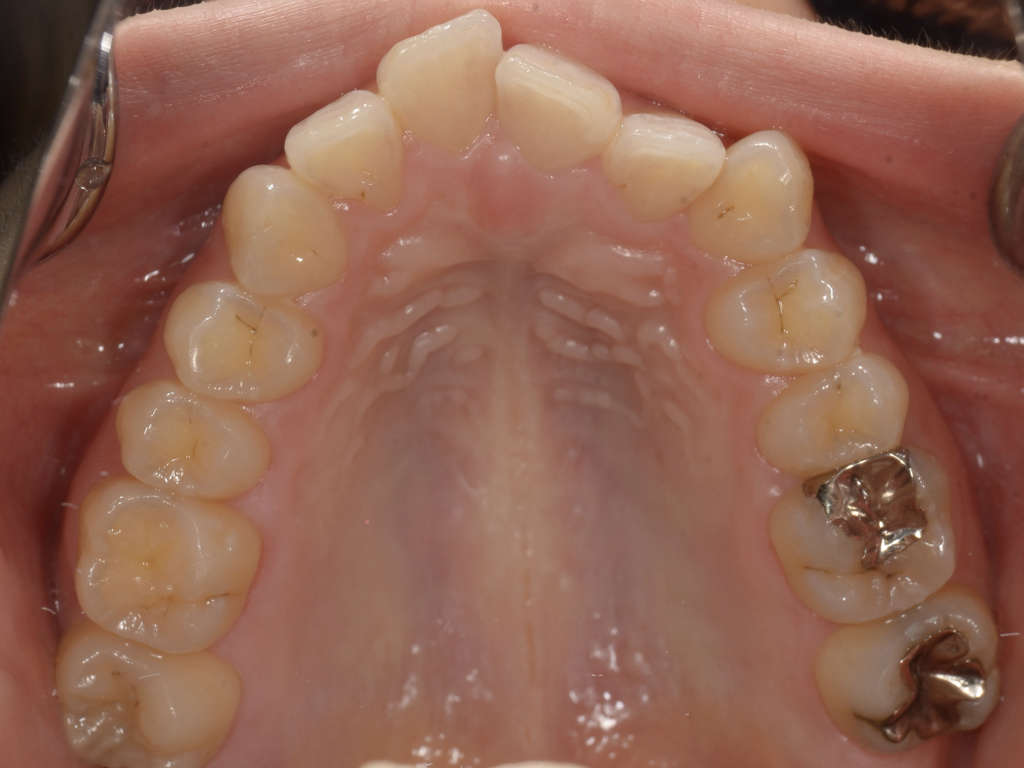 インビザライン矯正で、前歯の歯並びのコンプレックスを解消！