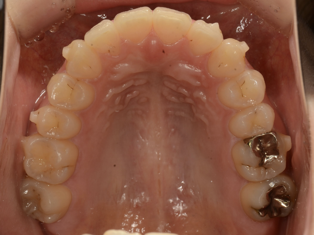 インビザライン矯正で、前歯の歯並びのコンプレックスを解消！