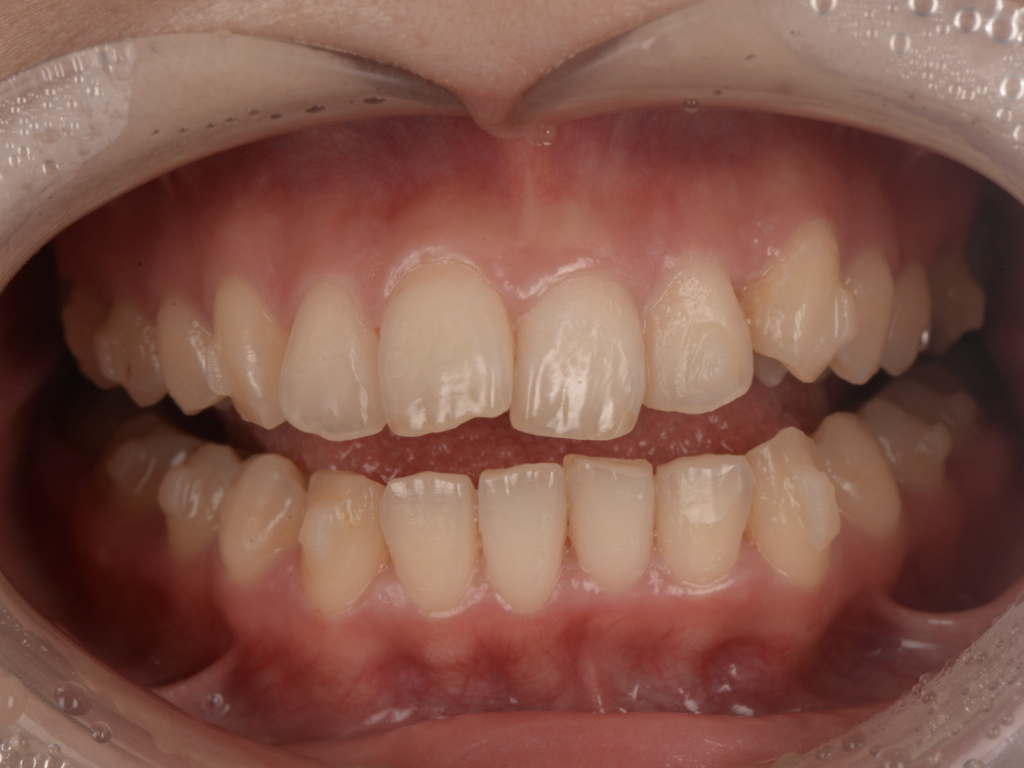 インビザライン矯正で、前歯の歯並びのコンプレックスを解消！