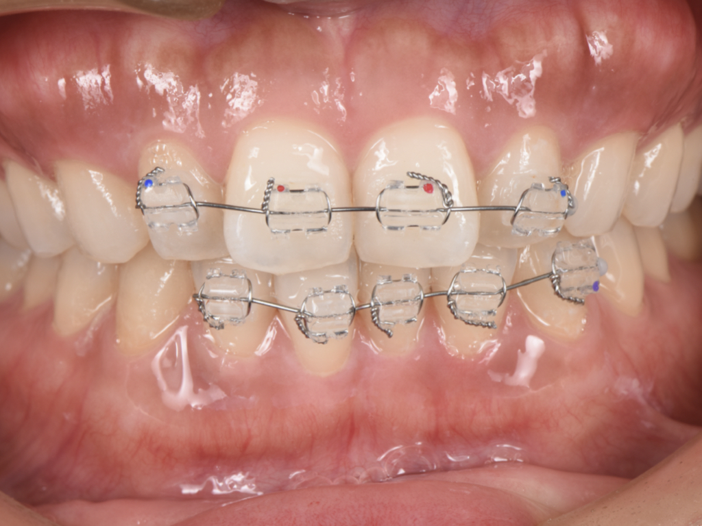 早く終わる矯正治療の症例【軽度の前歯部矯正】