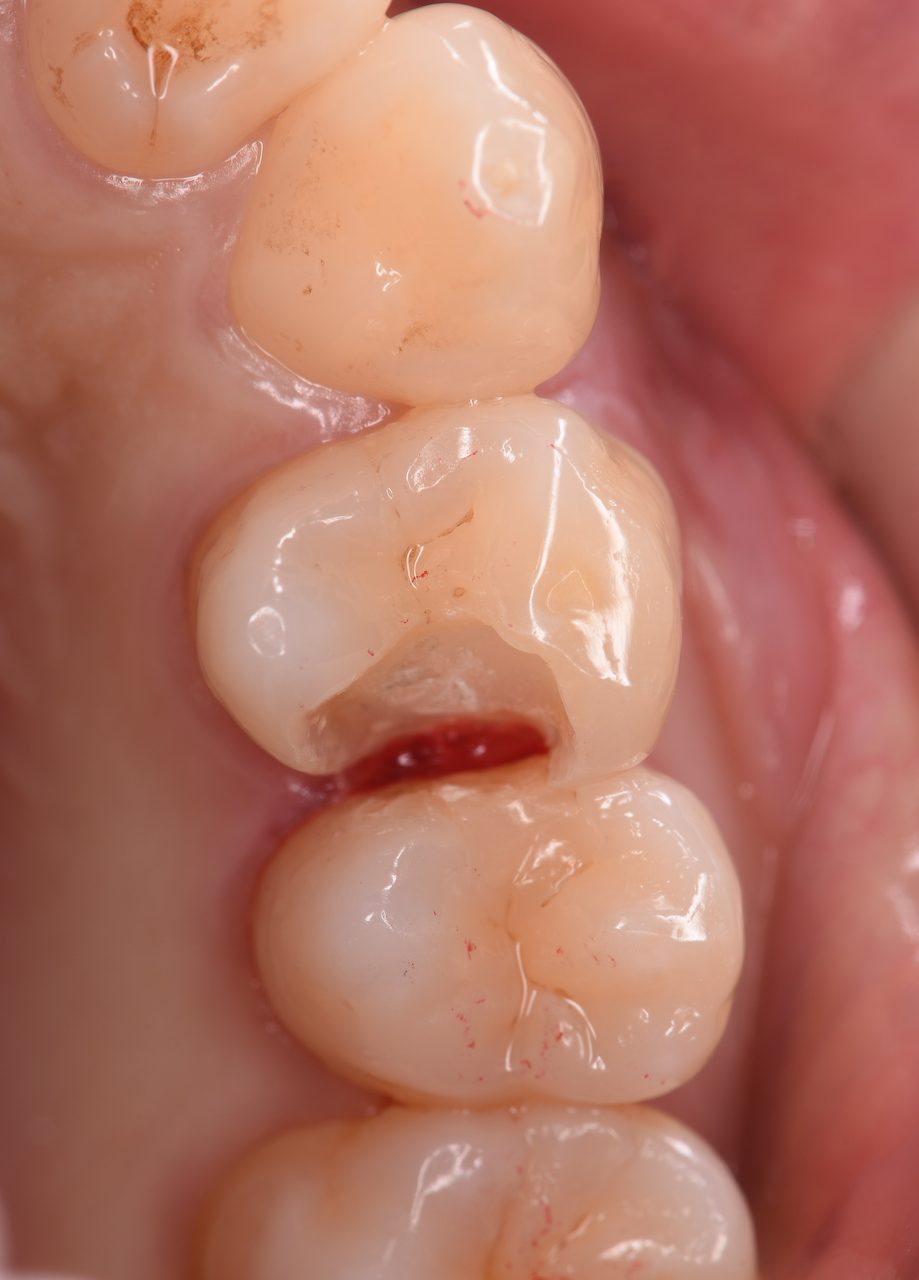 歯と歯の間にできた大きな虫歯を、ダイレクトボンディングで治療した症例