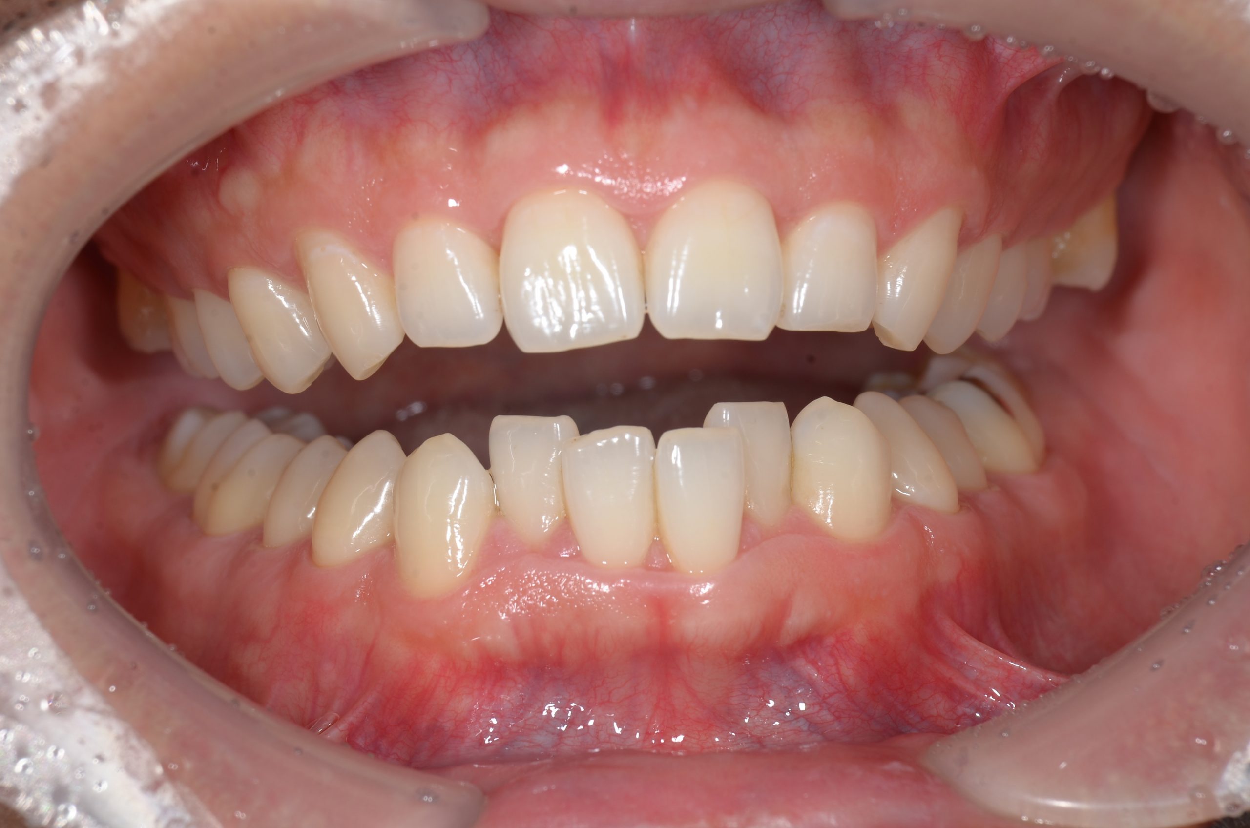 前歯のみのワイヤー矯正で歯並び改善！