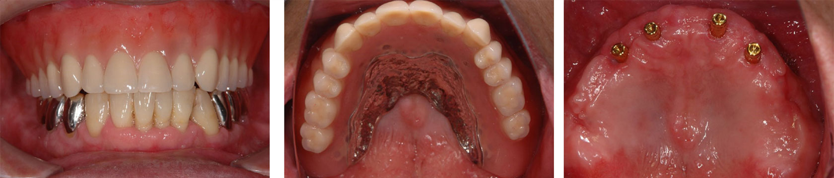 快適に噛める、インプラントと入れ歯の併用（インプラントオーバーデンチャー）