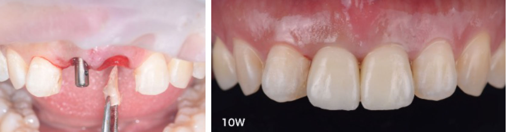 治療後に差が出る「歯ぐきの見た目」