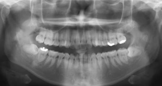 パノラマレントゲンで歯・顎骨を撮影