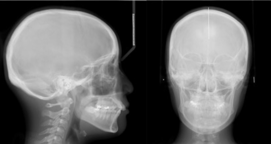 頭部X線撮影による骨格情報の収集