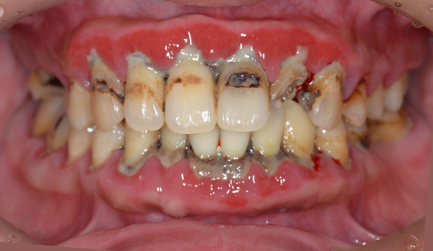 ■重度の歯周病（重度広汎型慢性歯周炎）にお悩みだった患者さま